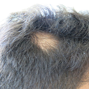 ریزش موی سکه‌ای(alopecia areata) یا بیماری اتوایمیونی چیست؟
